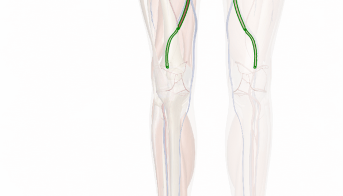 Bypass vascular peripheral vein saphenous femoropopliteal graft popliteal femoral artery incision procedure fem diseased